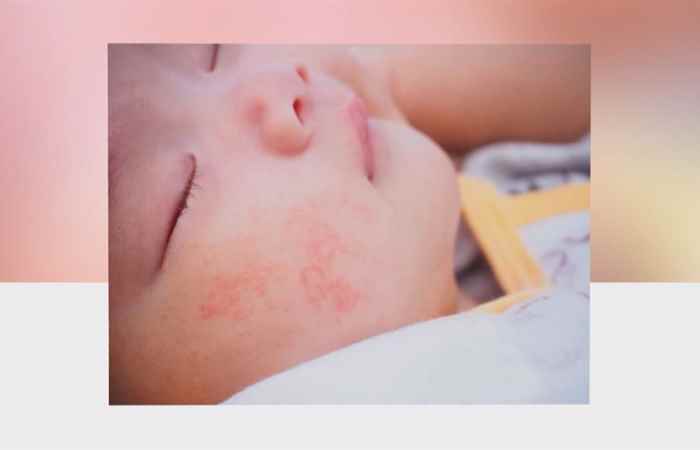 Sống khỏe 360 -  Dị ứng đạm sữa (21-05-2020)